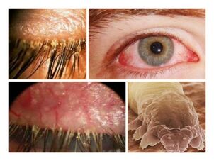 симптоми на наличие на паразити под човешката кожа